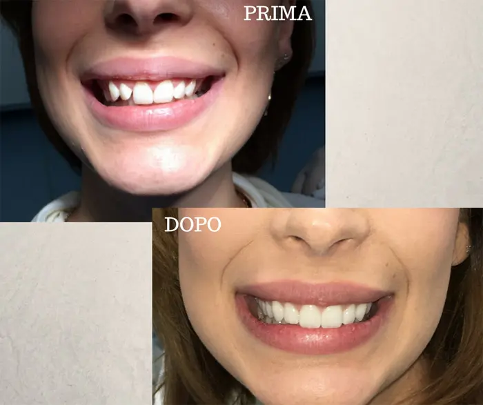 Prima e Dopo - Smile Makeover