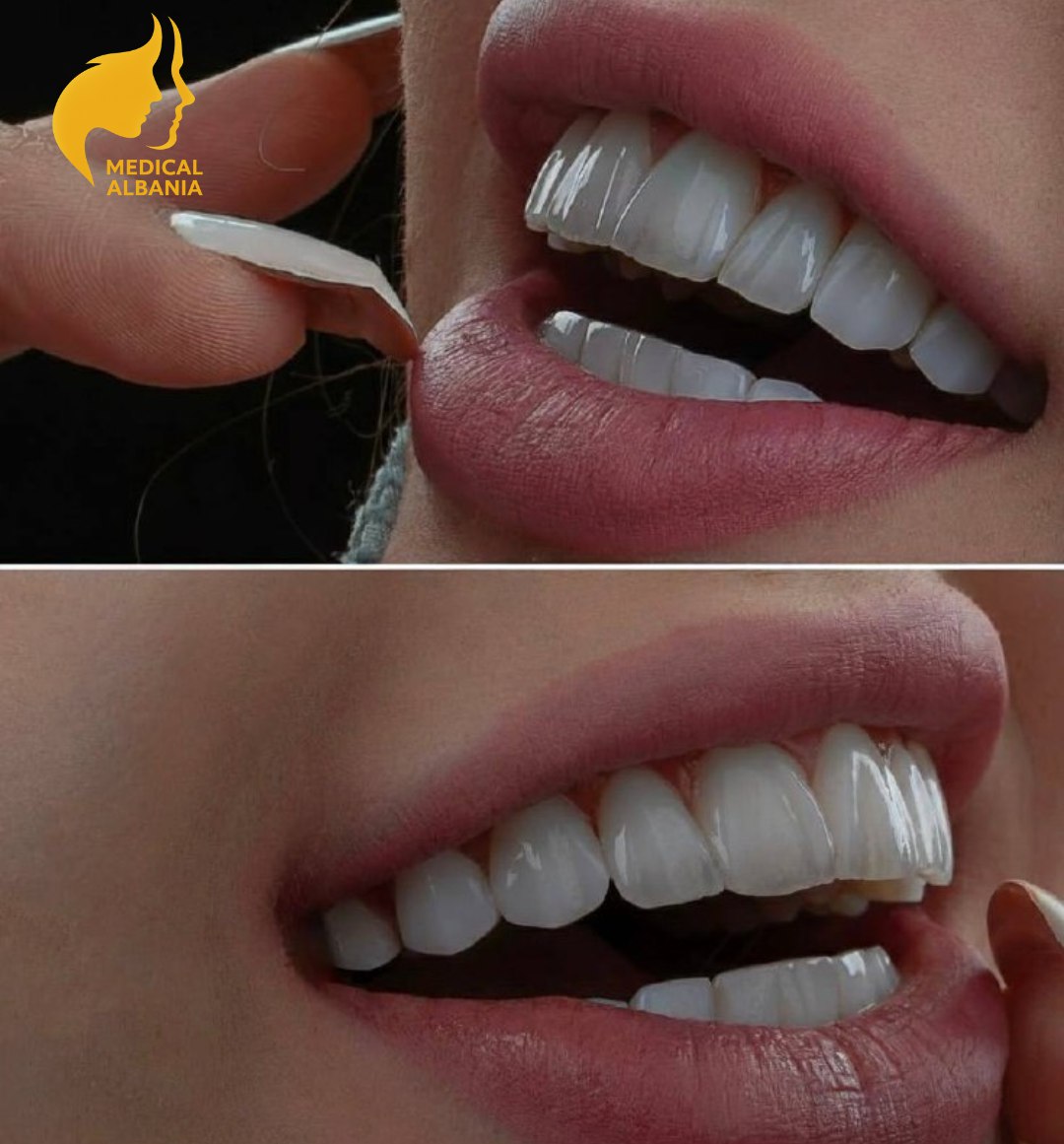 Prima e Dopo - Faccette