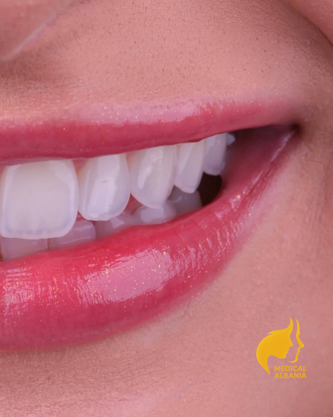 Prima e Dopo - Sorriso Perfetto